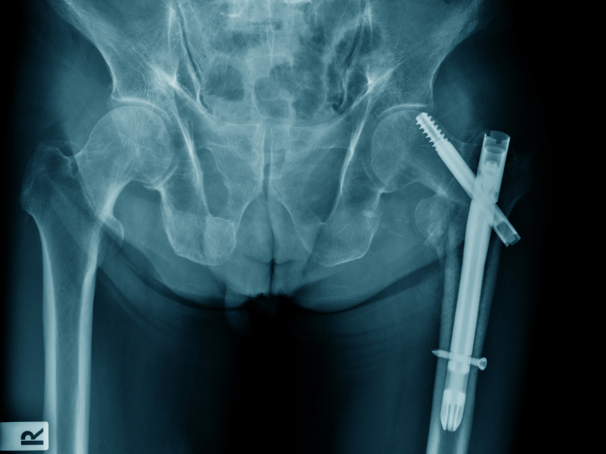 Hip Fractures